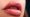 A pair of lips after lip fillers