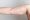 mottled skin on arm