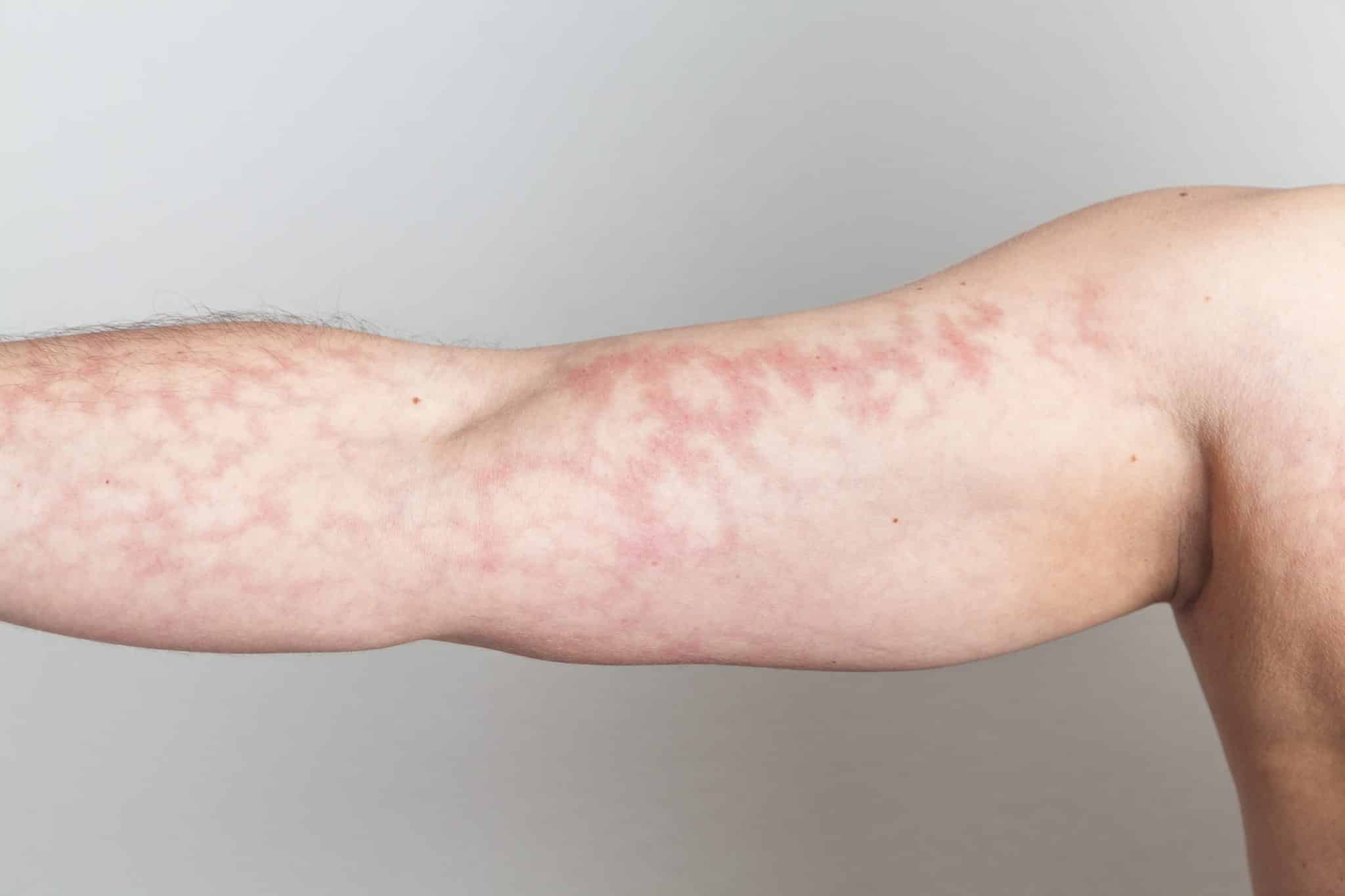 mottled skin on arm