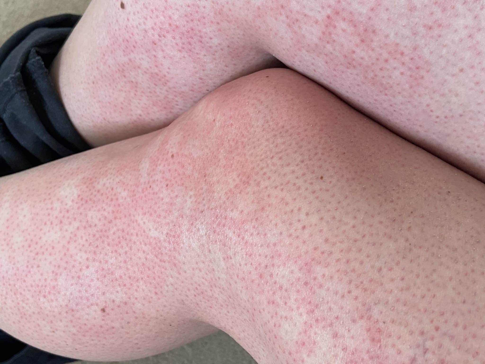 mottled skin on legs