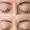 Xeomin before and after results on forehead lines.